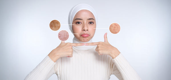 Hiperpigmentasi Bukan Takdir! Begini Cara Menghilangkan Flek Hitam dengan Tepat